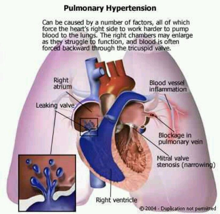 132 best Pulmonary Hypertension images on Pinterest