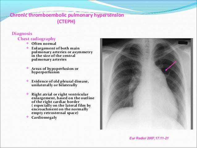 Chronic Thromboembolic Pulmonary artery Hypertension
