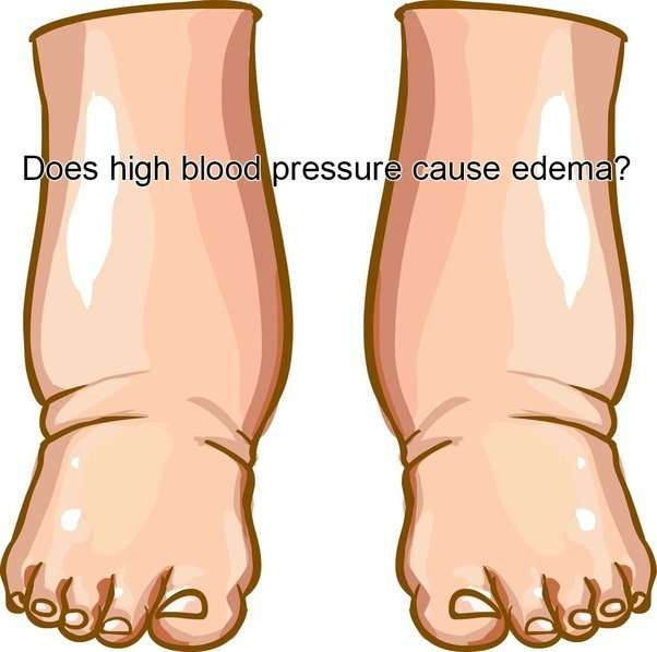 Does high blood pressure cause edema?