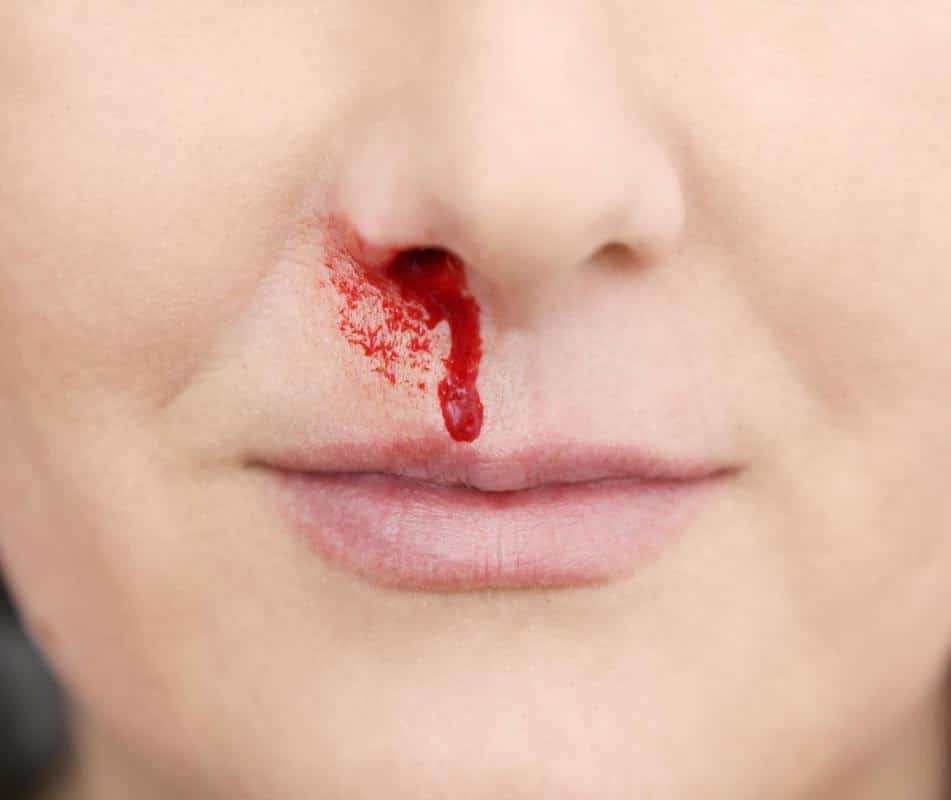 Five Reasons Why Causes Nosebleeds Blood Clots Is Common In USA ...