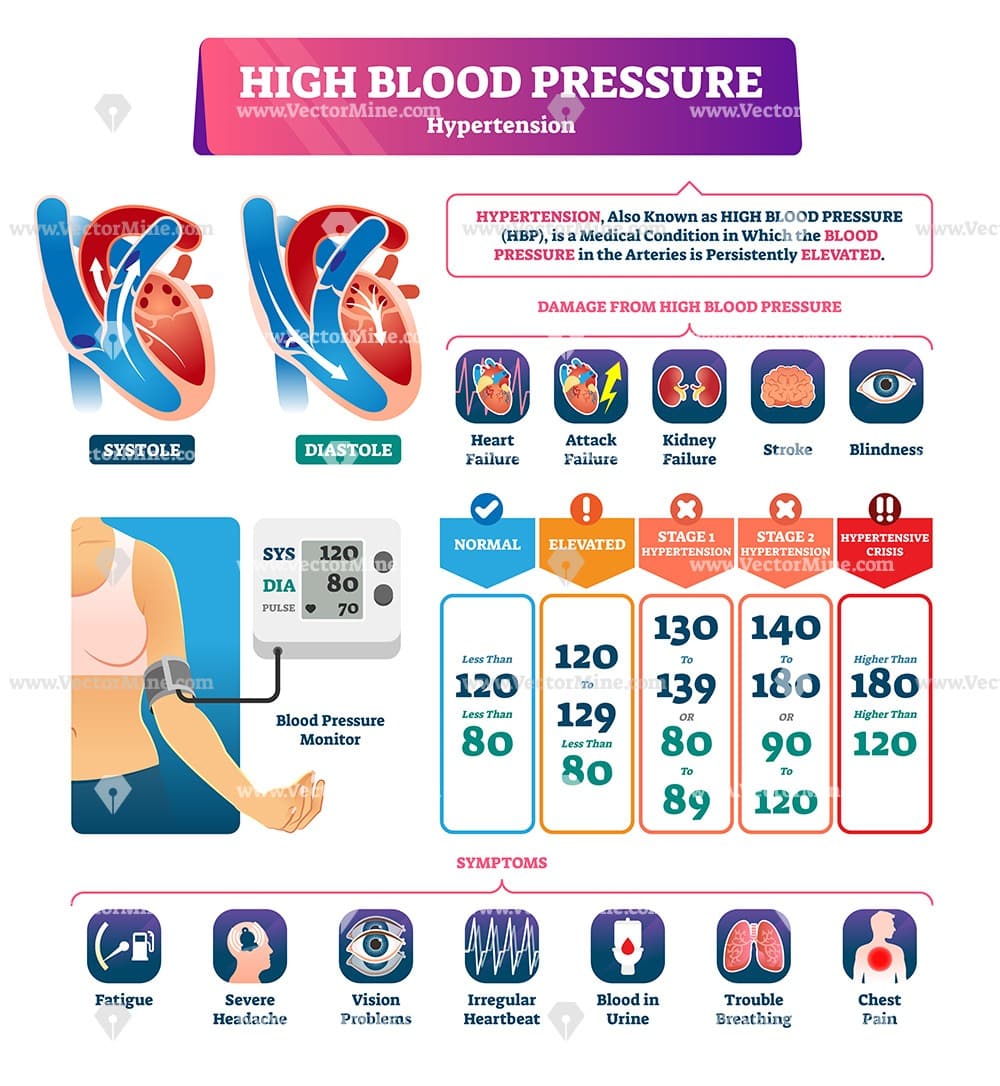 High blood pressure anatomical vector illustration infographic chart ...