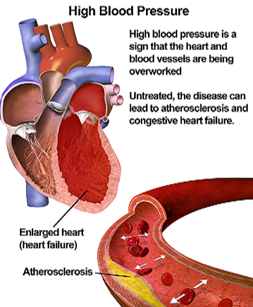 High Blood Pressure: Symptoms, Causes &  Remedies