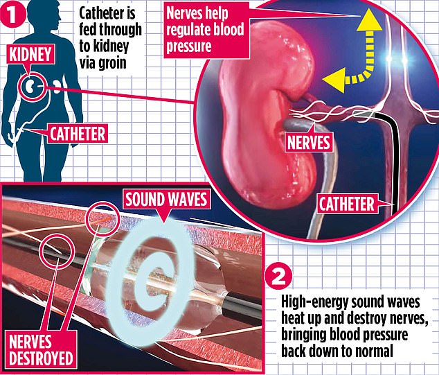 How a blast to the kidney could end high blood pressure for good ...