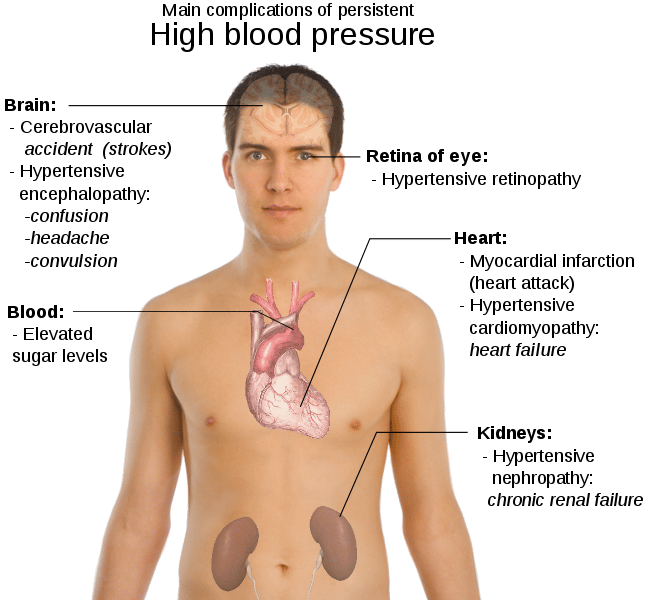 Hypertension and its causes