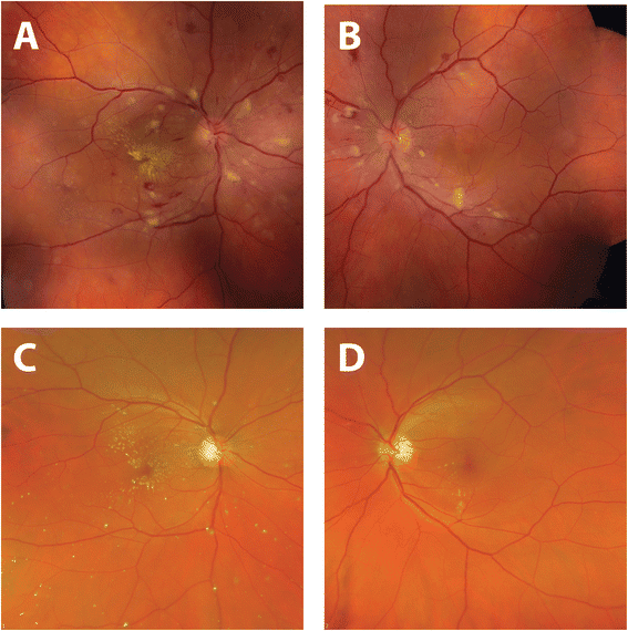 Hypertensive emergency presenting as blurry vision in a patient with ...
