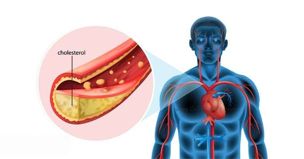 If You Are Suffering From High Blood Pressure, Bad Cholesterol, And ...