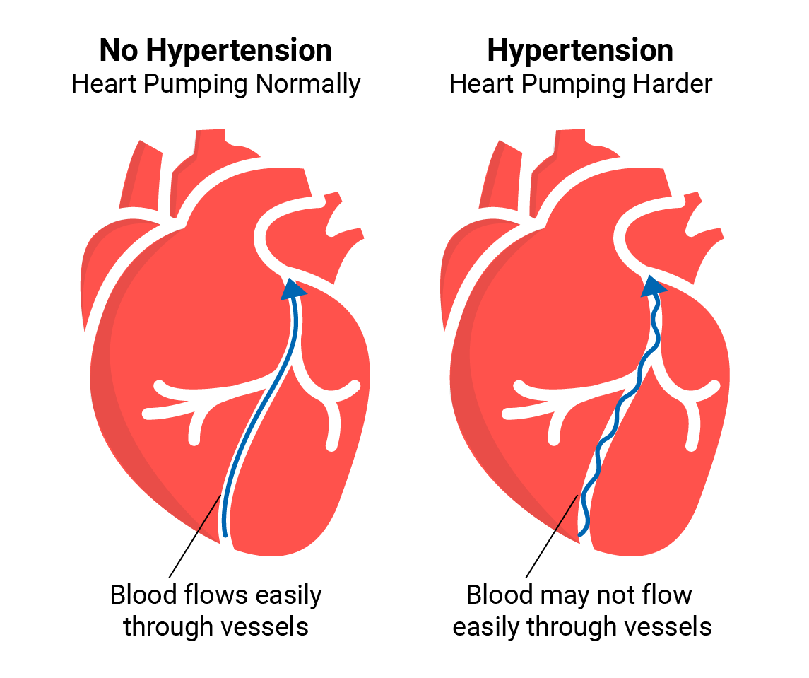 More Than a Measurement: Hypertension