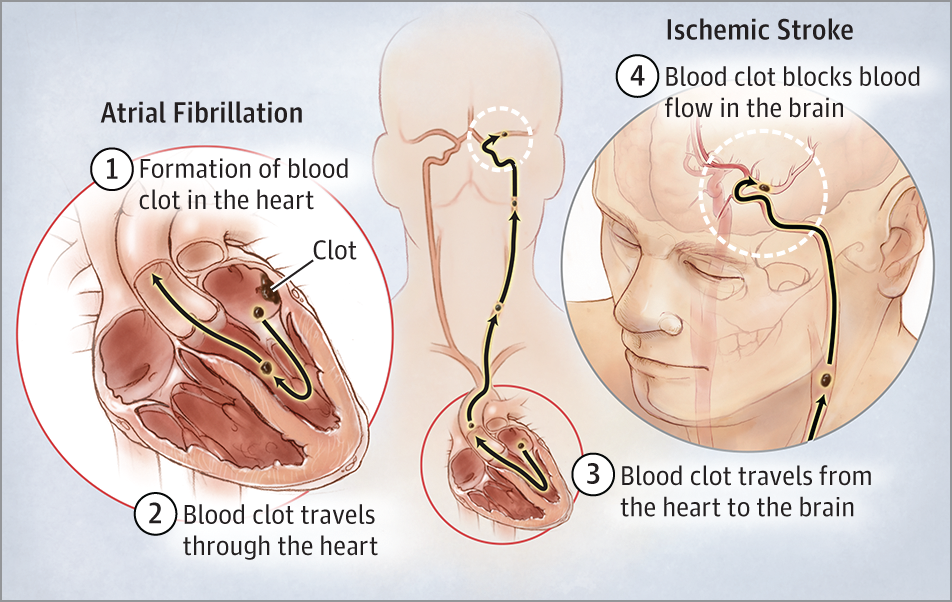 Preventing Stroke in People With Atrial Fibrillation ...