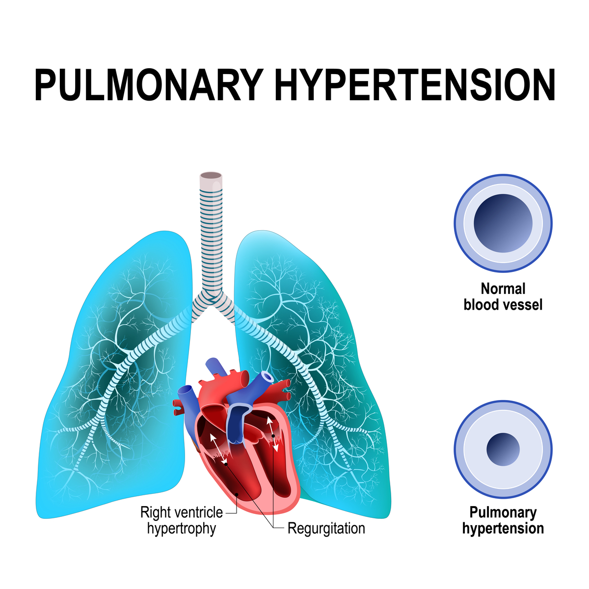 Pulmonary Hypertension: Learn about Symptoms and Diagnosis ...