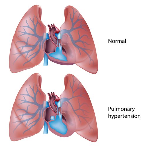 Pulmonary Hypertension Overview