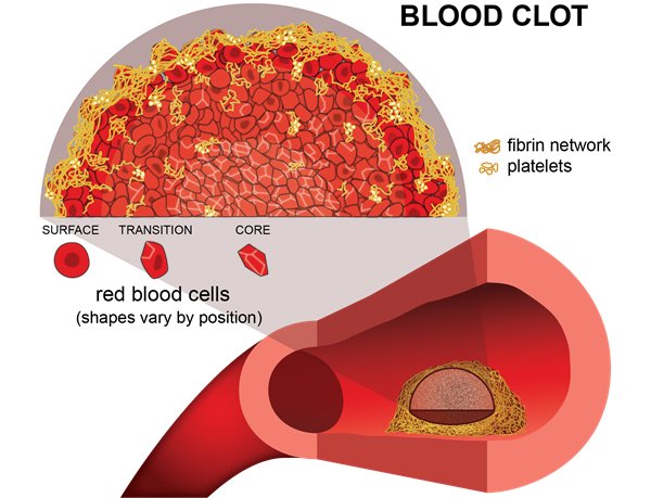 Researchers Optically Clear Blood Clots to Study Their ...