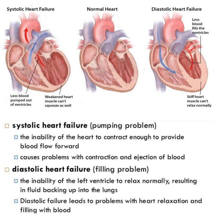 Systolic VS Diastolic Heart Failure