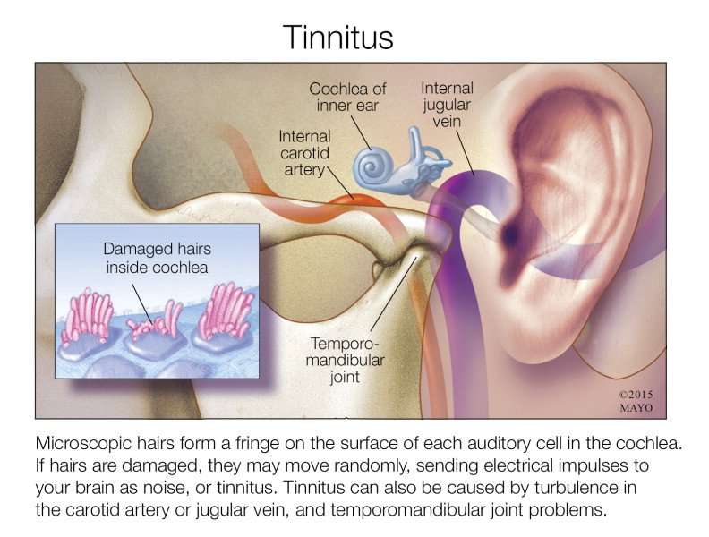 The More You Know: Tinnitus (Hearing Damage)