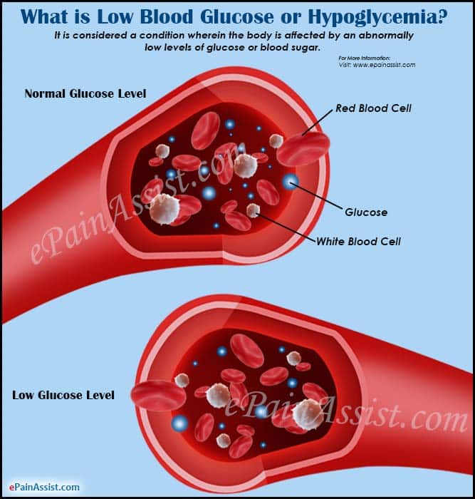 What Causes Low Blood Glucose or Hypoglycemia, Know its Signs, Symptoms ...
