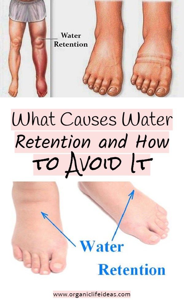 What Causes Water Retention and How to Avoid It