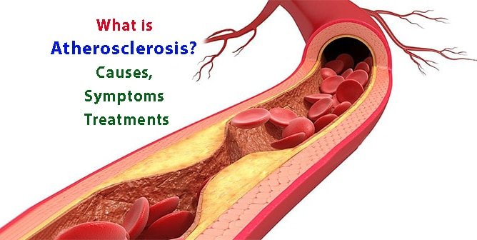 What is atherosclerosis? Causes, symptoms and treatments